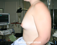 plastic-surgery-breast-augmentation